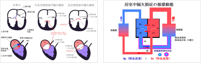 房室中隔欠損症（心内膜床欠損症）