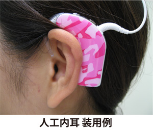 人工内耳装用例