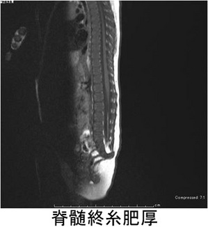 脊髄終糸肥厚