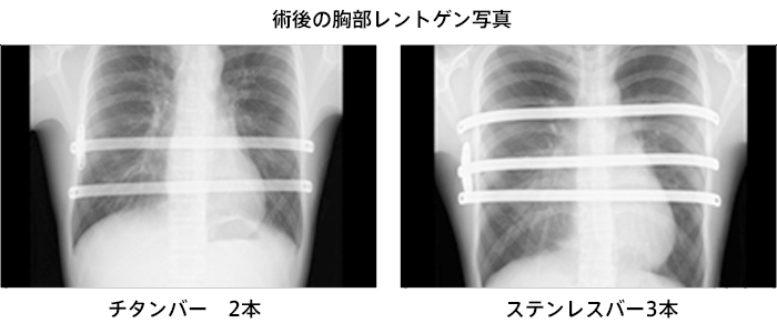 術後の胸部レントゲン写真